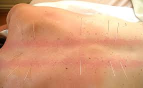 daomed Akupunktur-Behandlung am Rücken